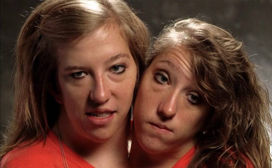 conjoined twins abby and brittany hensel engaged